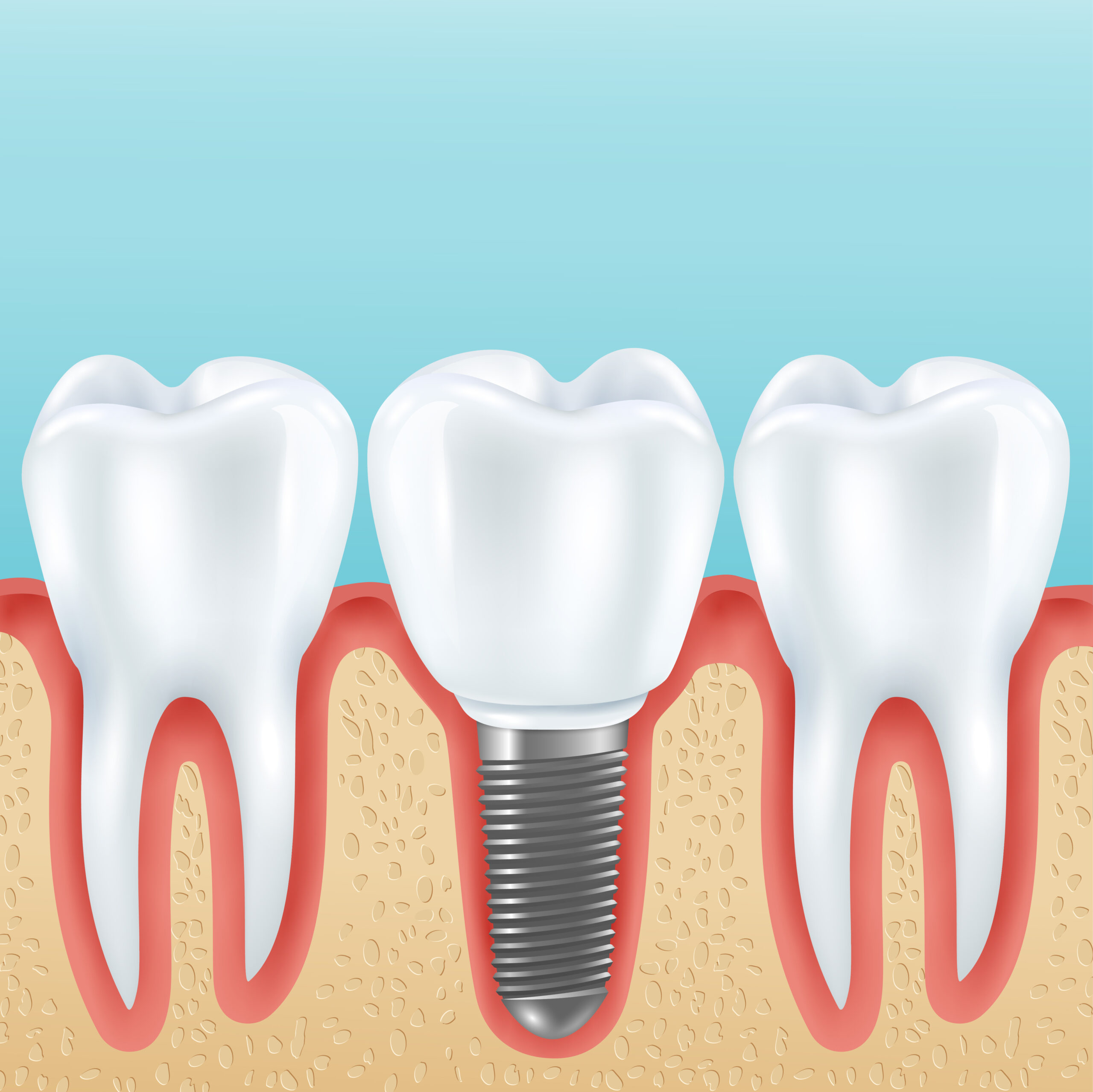 Read more about the article What Are the Three Types of Dental Implants?