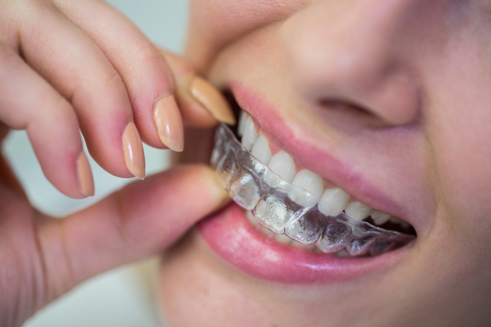 Read more about the article How to Take Care of Invisalign And Clear Aligners : Expert Tips for Faster Results and a Healthier Smile